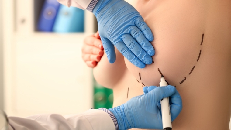 Breast Surgery for Trans Women: Everything You Need to Know 1 turkey ffs