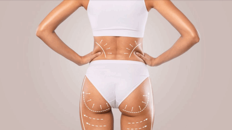 Is Fat Transfer (BBL) Suitable for Trans Women? Revealing Feminine Lines 1 IMG 2747