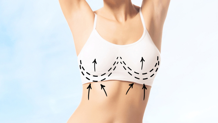 For a Feminine and Striking Breast Silhouette: Breast Implants or Fat Transfer? 1 dr mfo
